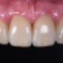 Smile Makeover - After