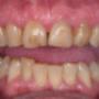 Smile Makeover - Before