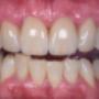 Smile Makeover - After 2