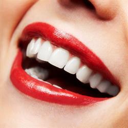 Sparklewhite Teeth (Teeth Whitening Service)