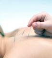 acupuncture
