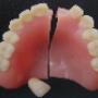 Denture Repair