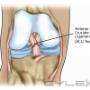 Uploaded by visitor on 28/09/2016 - ACL Tear