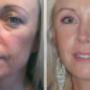 Dermal fillers