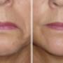 Downward mouth lines