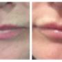 lip fillers