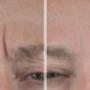Forehead lines