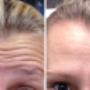 Frown Lines Removal