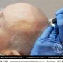 Scalp MicroPigmentation Auckland - Melissa Carr Cosmetic Tattoo