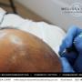 Scalp MicroPigmentation Auckland - Melissa Carr Cosmetic Tattoo