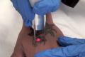 Tattoo-removal