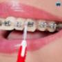 Braces Auckland