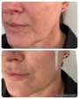Jawline improvement after PDO Threadlift