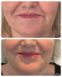 Before and after non-surgical facelift