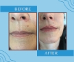 Before and after lip filler at Satini Cosmetic Clinic