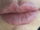 After 1 ml lip filler to correct lip shape