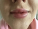 After Lip Filler