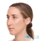 After dermal filler, Olivier