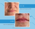 Lip Filler
