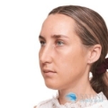 Dermal Filler