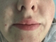 Before Lip Filler