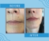 Before and after lip filler at Satini Cosmetic Clinic