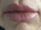 Correction of lip asymmetry