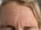 Frown lines after