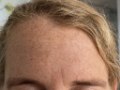 Botox