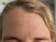 Frown lines before and after
