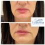 Before and after dermal filler treatments to rejuvenate the lower face.