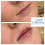Before and after lip enhancement using dermal fillers.