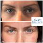 Before and after tear trough filler.