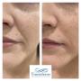 Before and after dermal filler treatment to minimise the appearance of nasolabial folds.