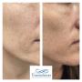 Before and after cosmetic injectables to improve skin quality and rejuvenate the lower face.