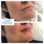 Before and after lip enhancement using dermal fillers.