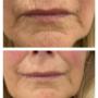 Before and after dermal fillers to minimise the appearance of fine lines.