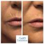 Dermal filler to treat lip line.