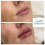 Before and immediately after lip filler treatment. Individual results may vary.