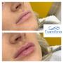 Before and immediately after lip filler treatment. Individual results may vary.