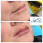 Before and immediately after lip filler treatment. Individual results may vary.