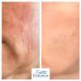 Before and after biostimulant injectable treatments to rejuvenate the lower face and skin quality.