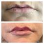 Before and immediately after lip filler treatment. Individual results may vary.