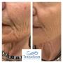 Before and after dermal filler treatment
