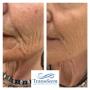 Before and after dermal filler treatment