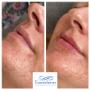 Before and immediately after lip filler treatment. Individual results may vary.